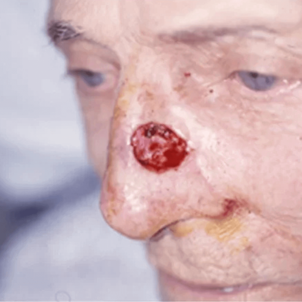 Skin Cancer Treatment