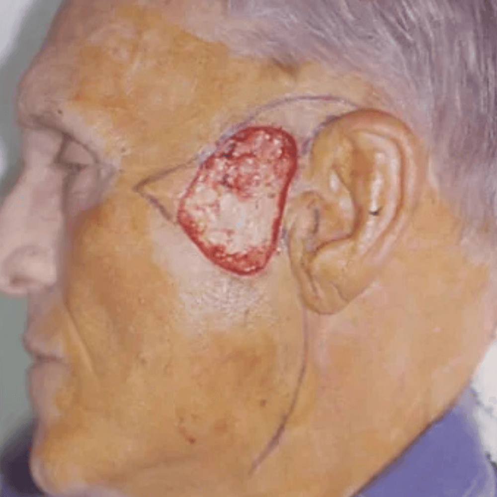 Skin Cancer Treatment