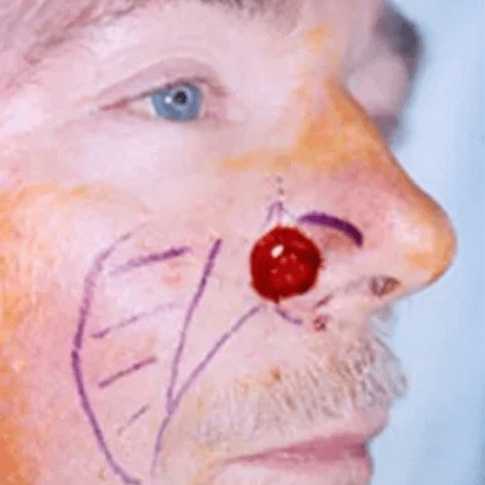 Skin Cancer Treatment