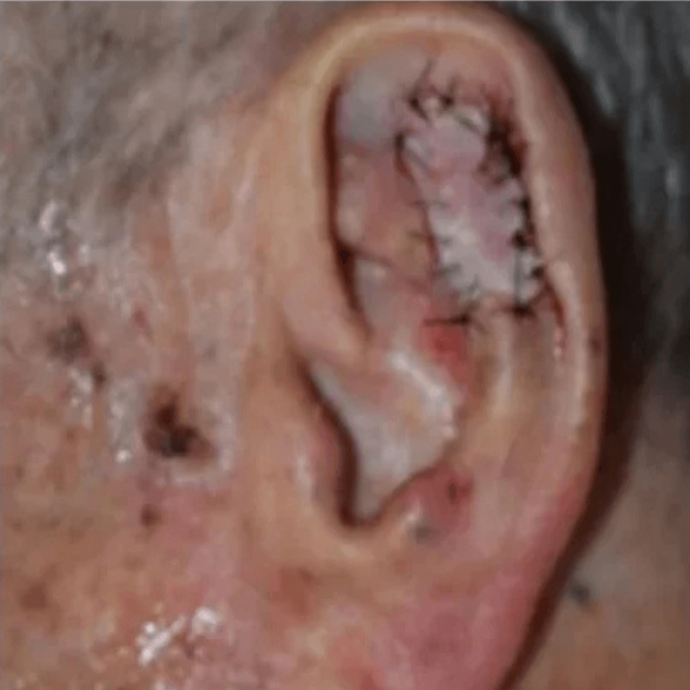 Skin Cancer Treatment