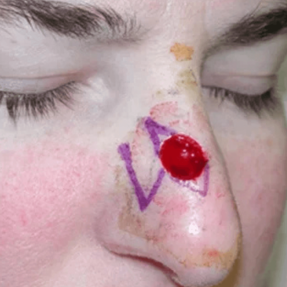 Skin Cancer Treatment