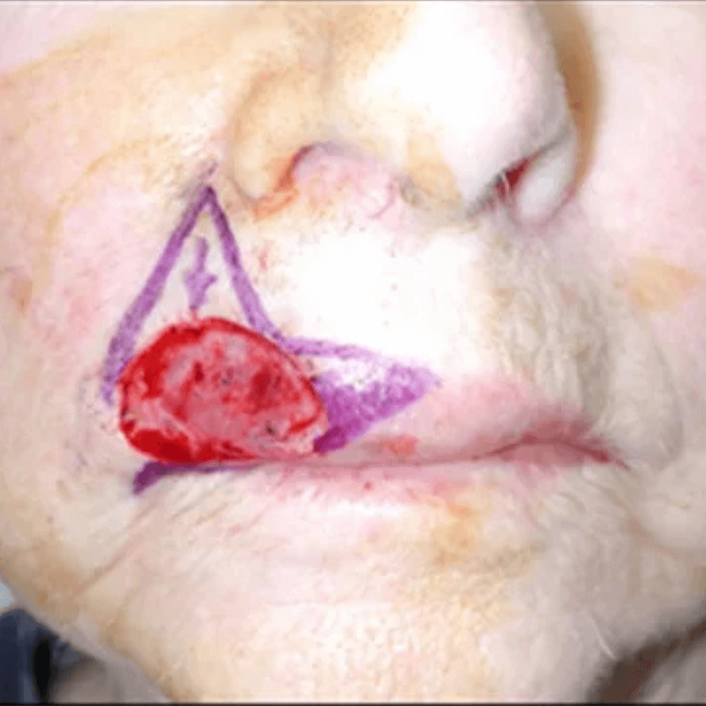 Skin Cancer Treatment