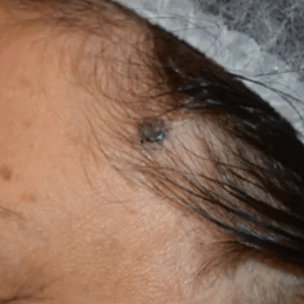 Skin Cancer Treatment