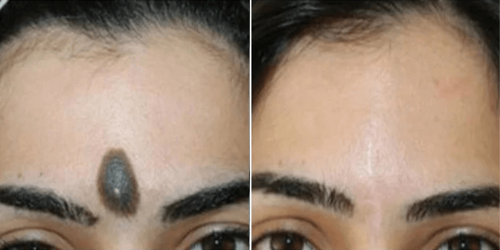 Surgery for Benign Lesions