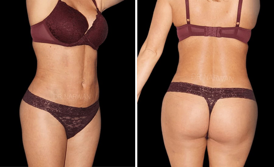treatment-women-body-05-dr-narwan-plastic-aesthetic-surgeon-dubai