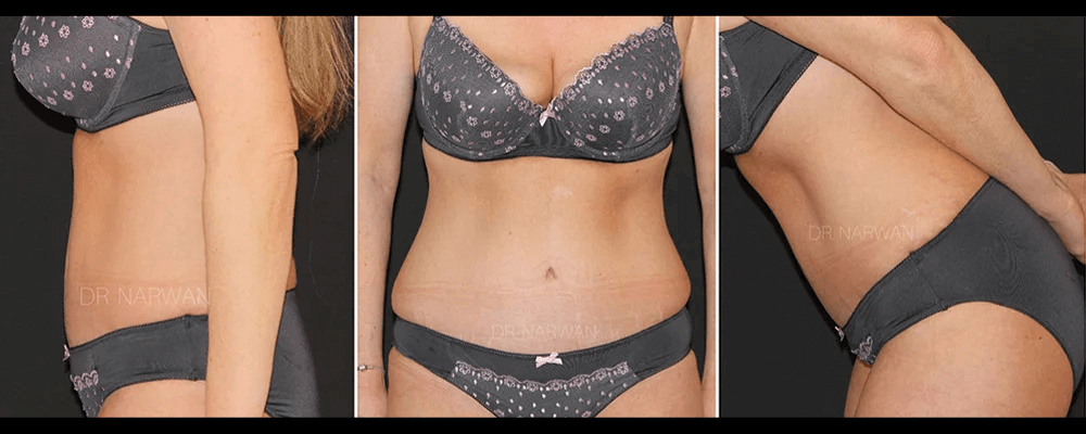 treatment-women-body-06-dr-narwan-plastic-aesthetic-surgeon-dubai