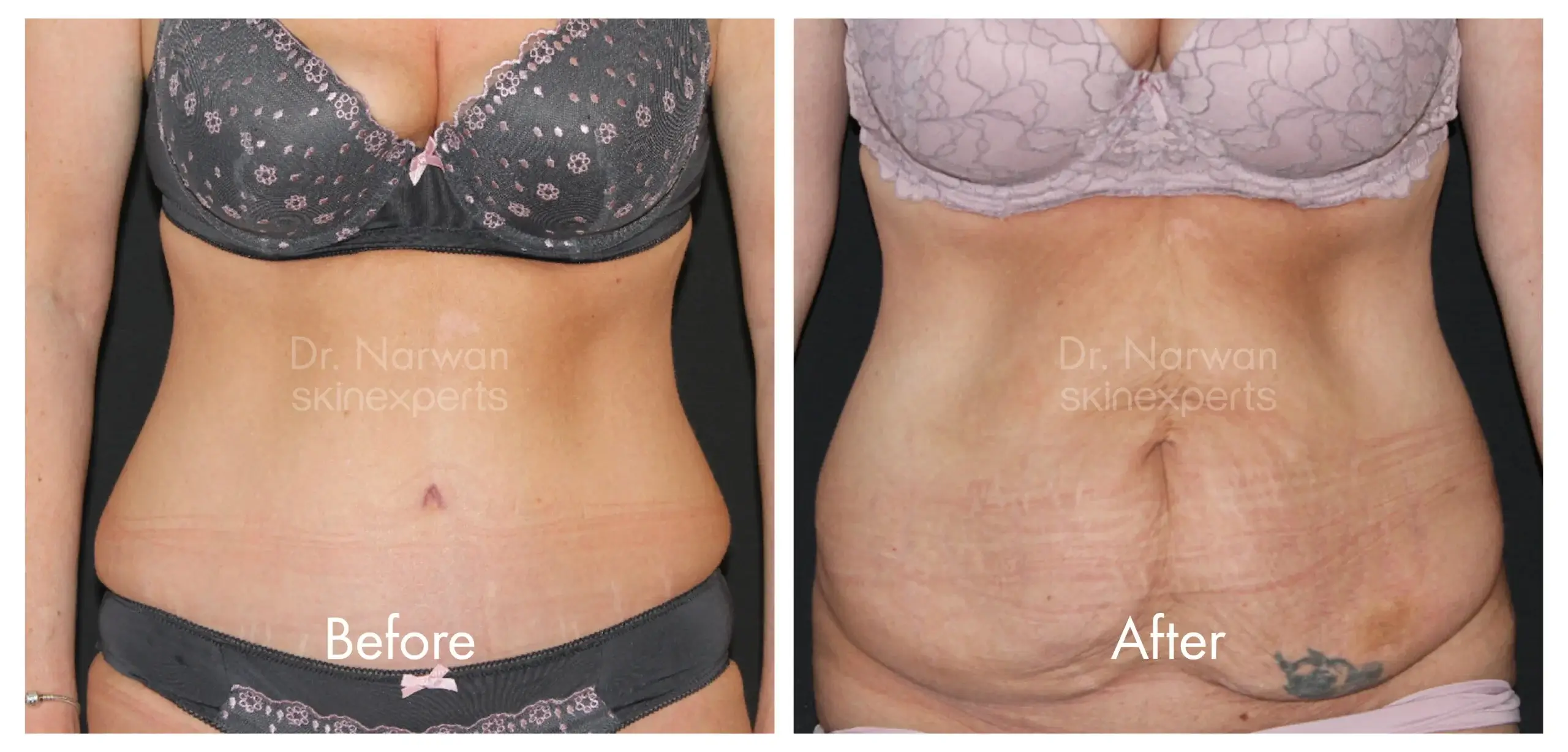 Tummy Tuck