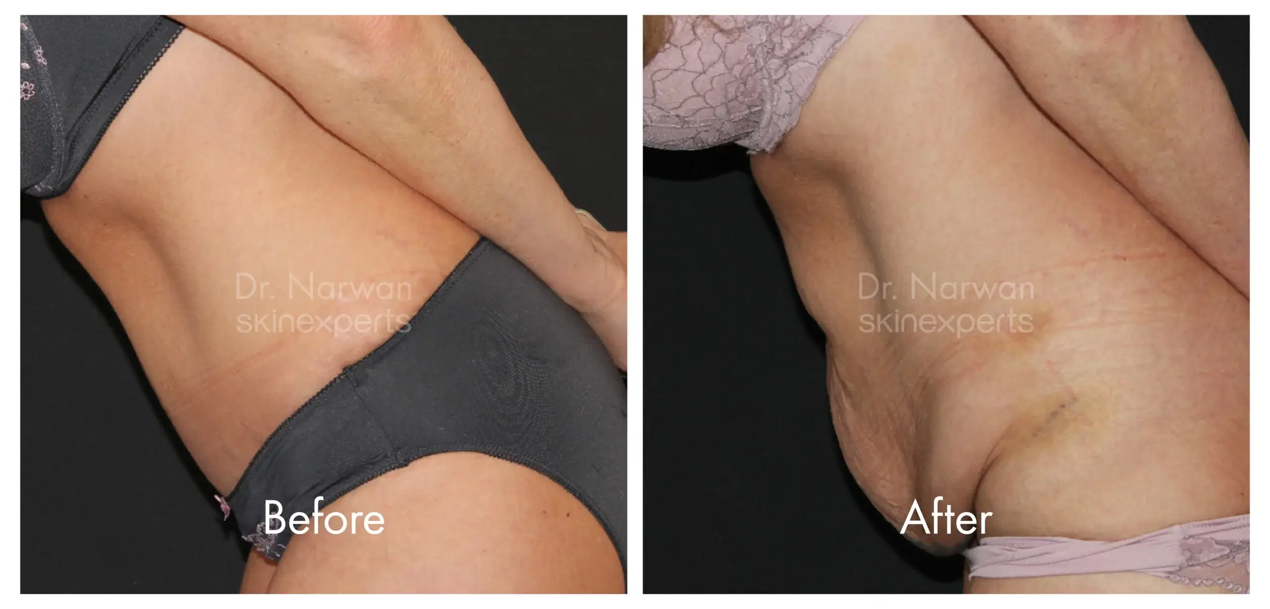 Tummy Tuck