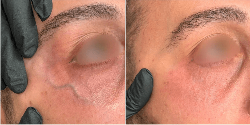 Vascular laser Treatment