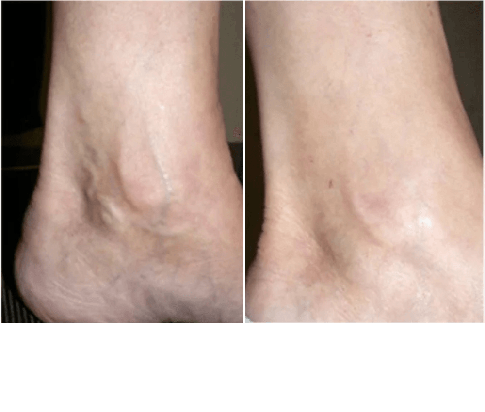 Vascular laser Treatment