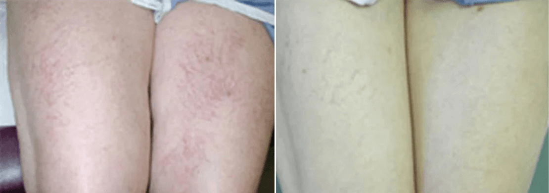 Vascular laser Treatment