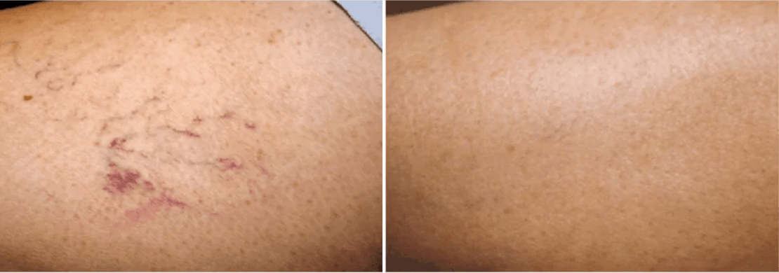 Vascular laser Treatment
